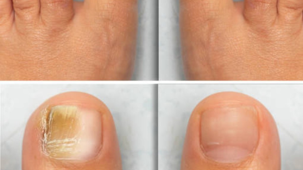 Fungal Nails