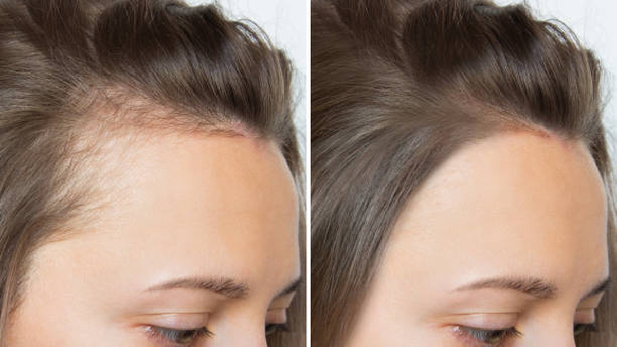 Hair Growth
